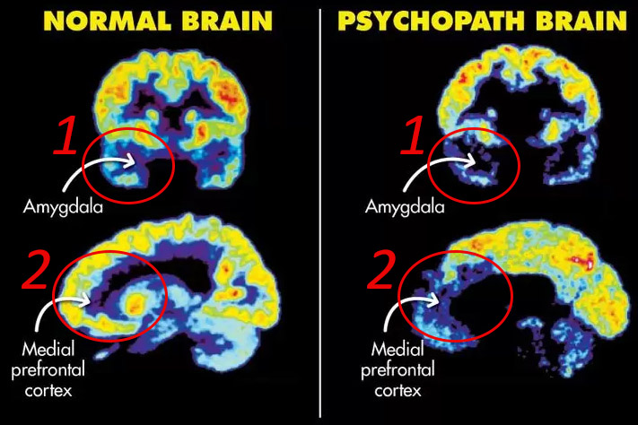 Psychopata - jak wygląda mózg psychopaty?